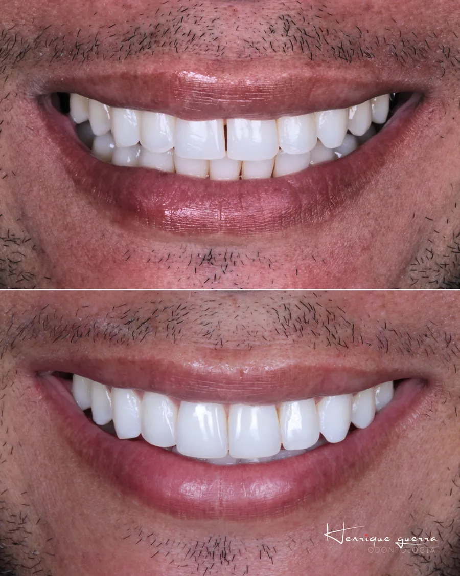Antes e depois: clareamento e ajuste de formato