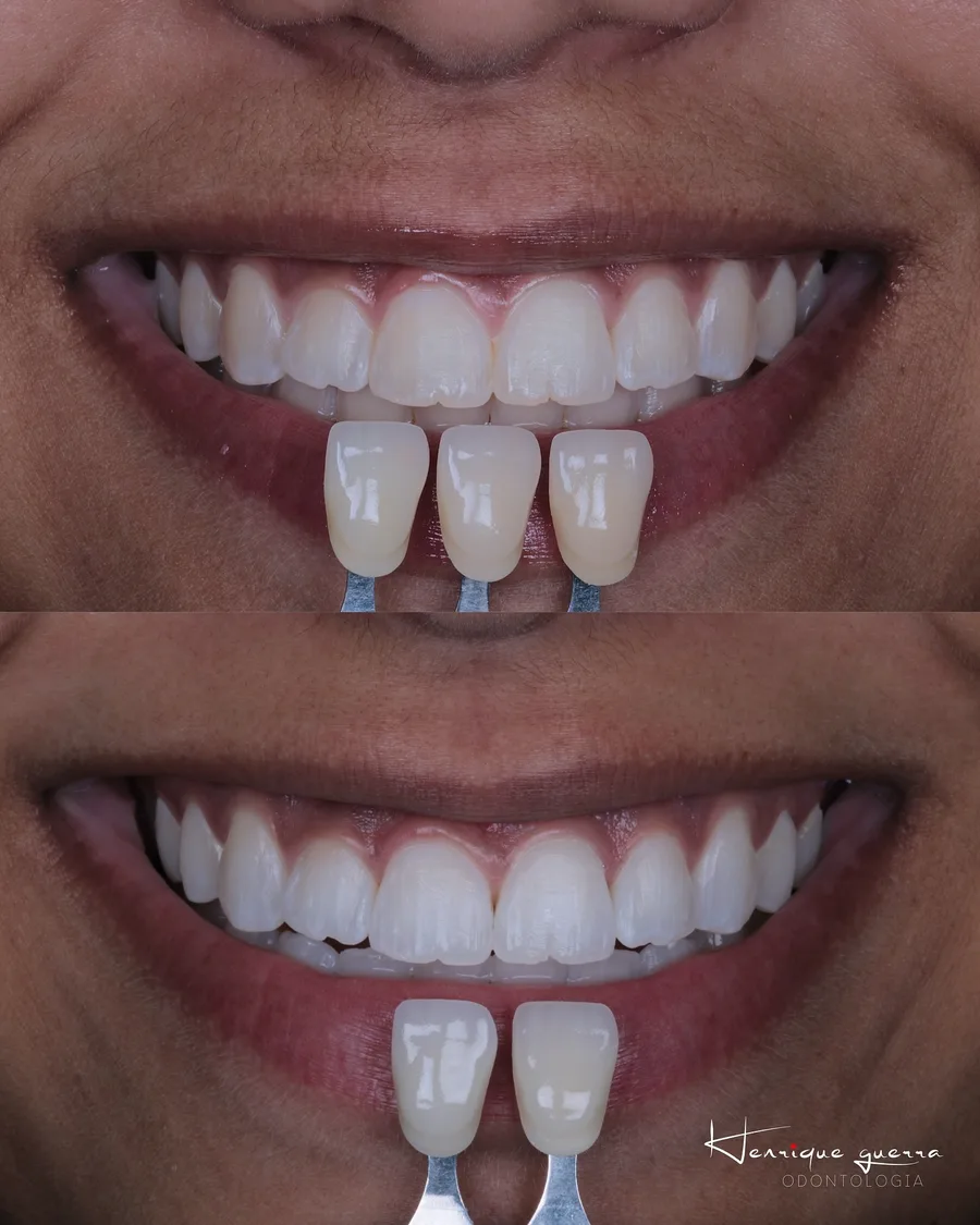 Antes e depois: clareamento dental com escala de cor