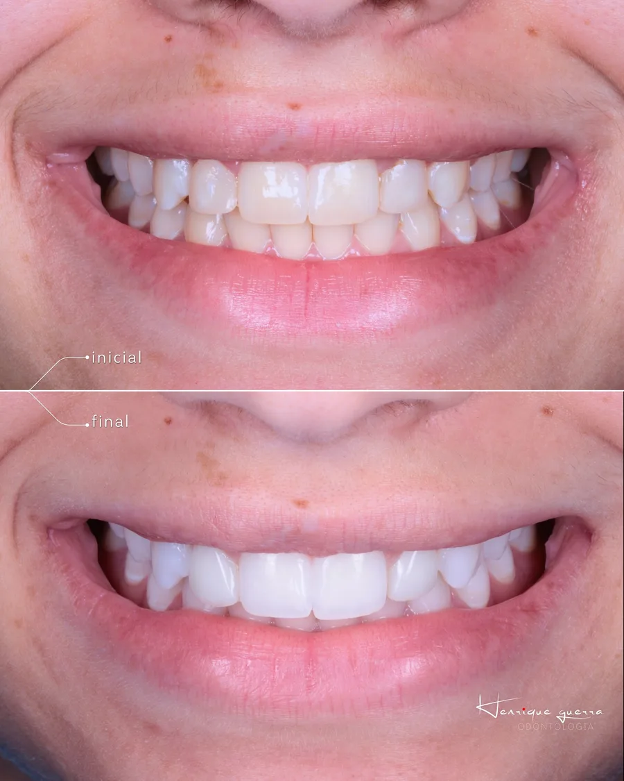 Antes e depois: dentes conoides