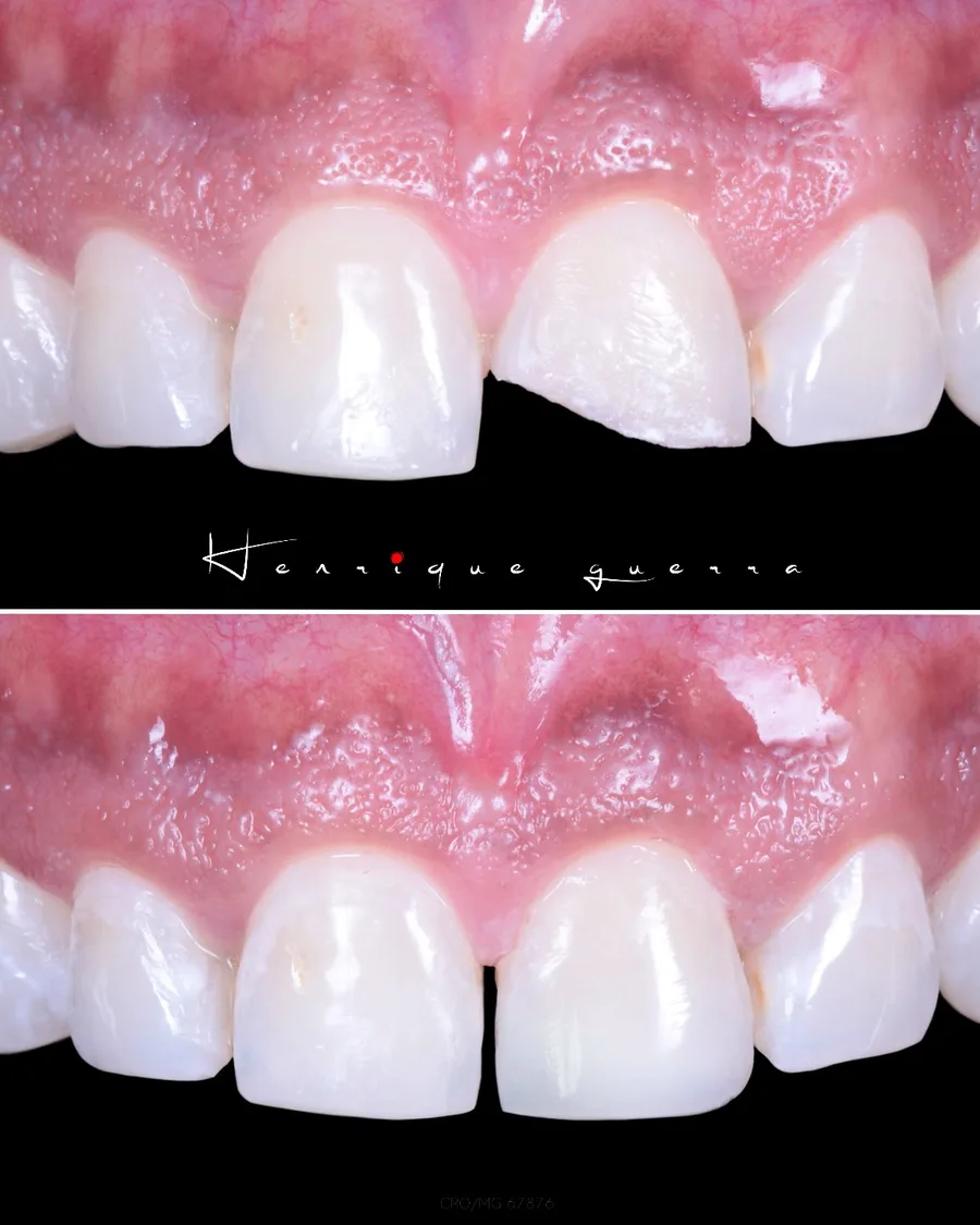Antes e depois: diastema