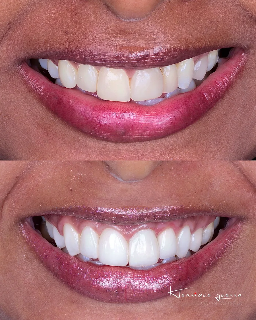 Antes e depois de reabilitação oral multidisciplinar