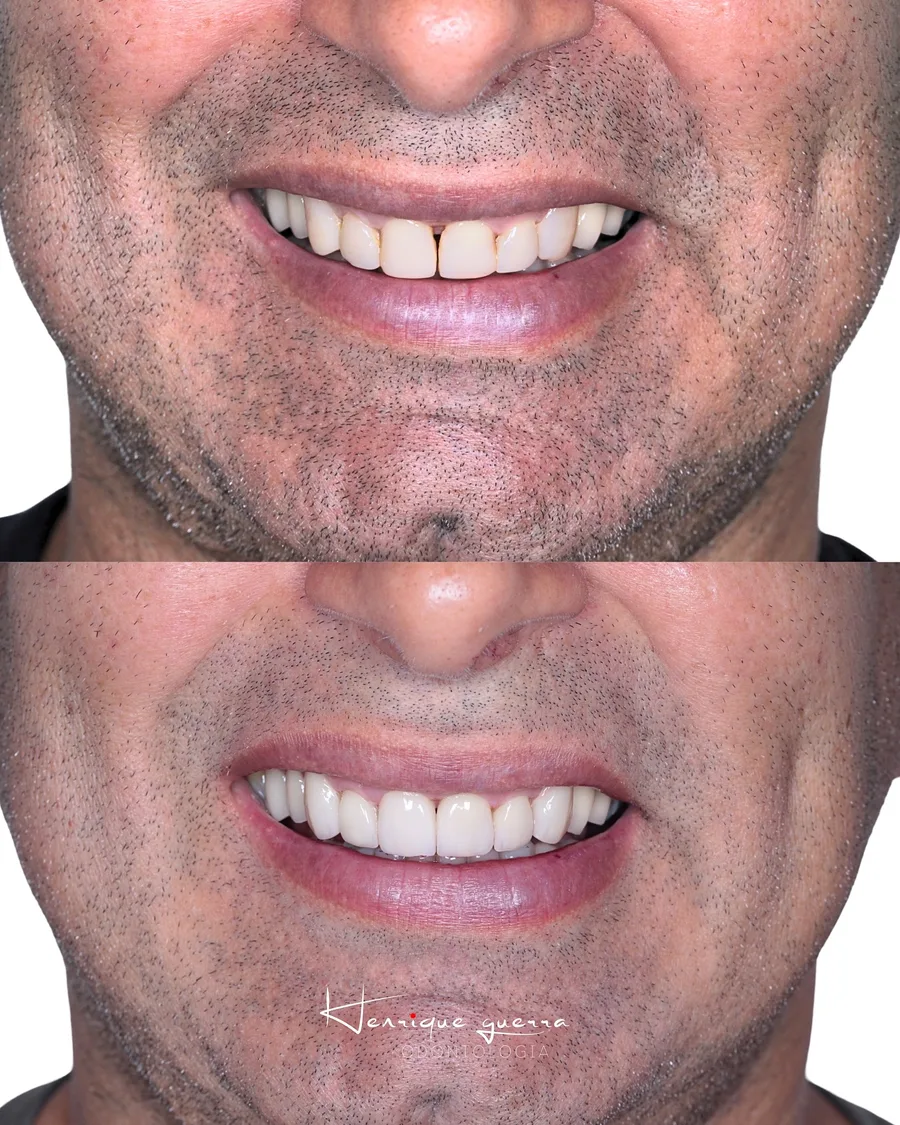 Antes e depois: facetas de porcelana