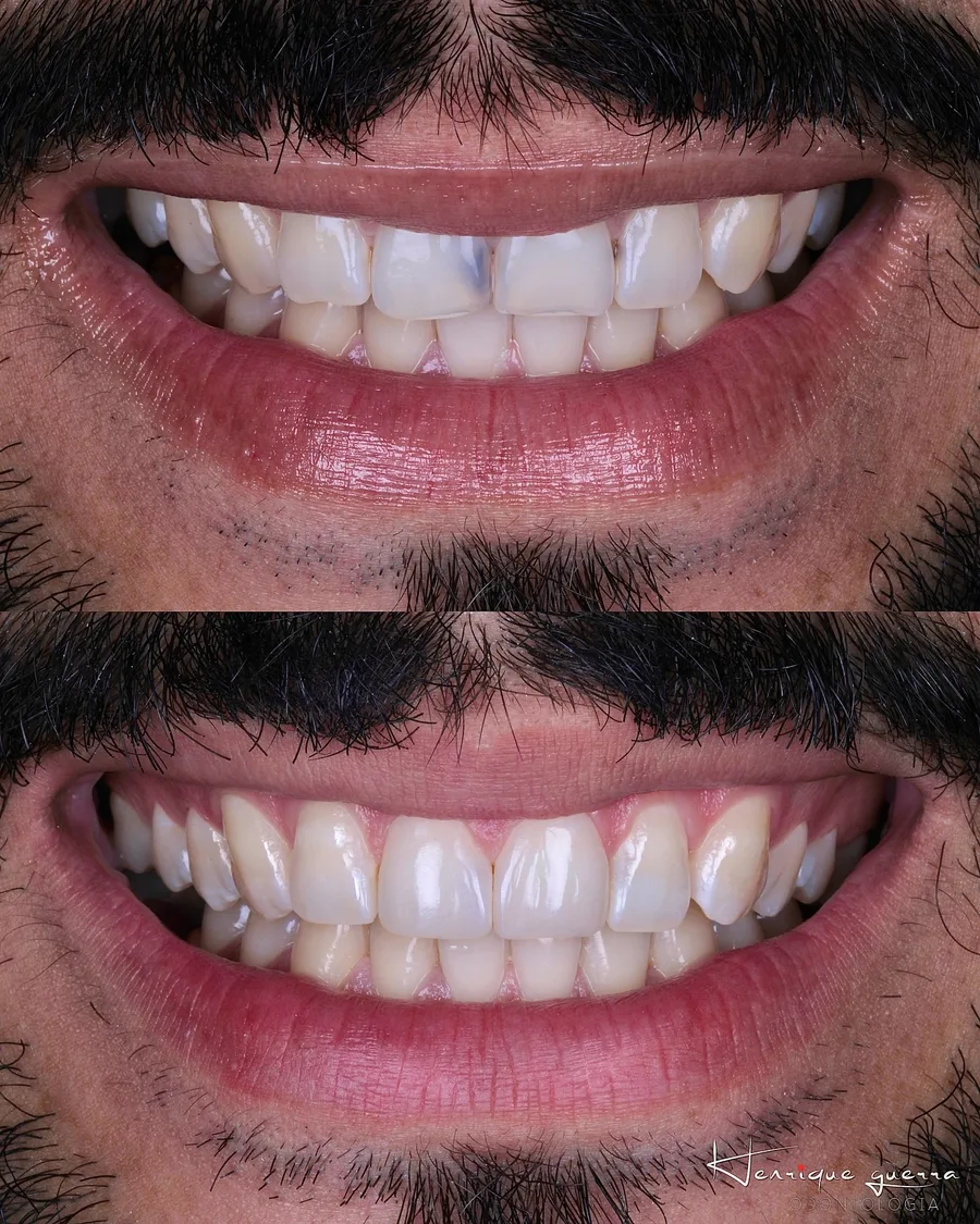 Antes e depois: restaurações estéticas